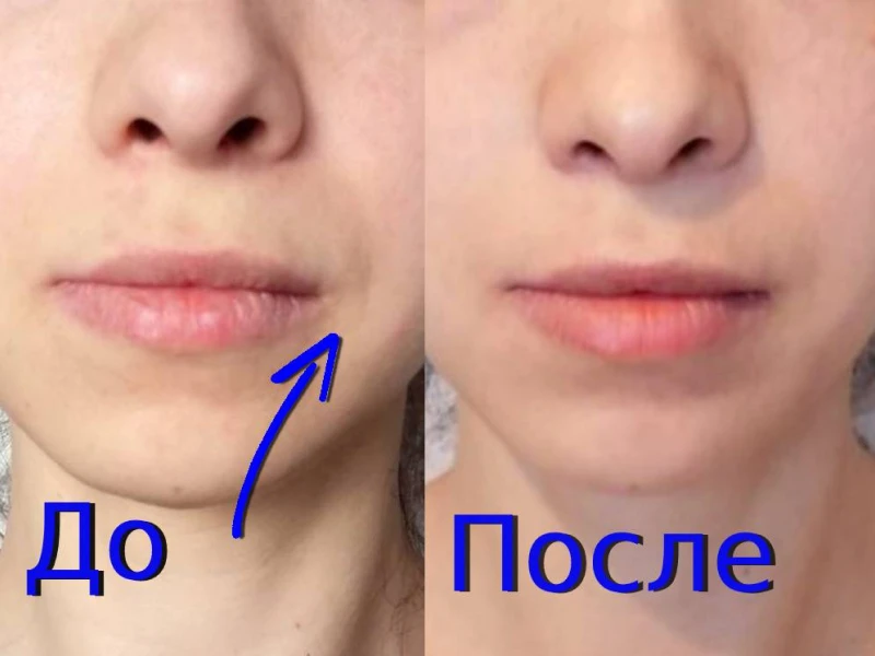 тейпирование до и после